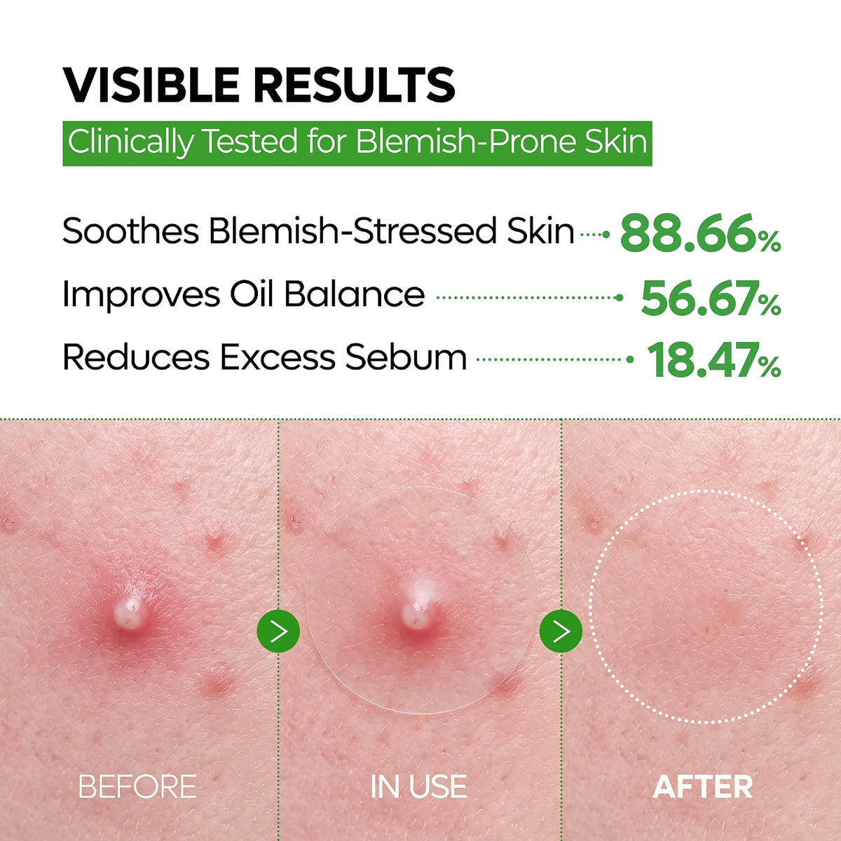 Dr.Melaxin S-ZINC ZERO-FIT Ultra Thin Blemish Spot Patch 0.013mm Invisible Pimple Stickers